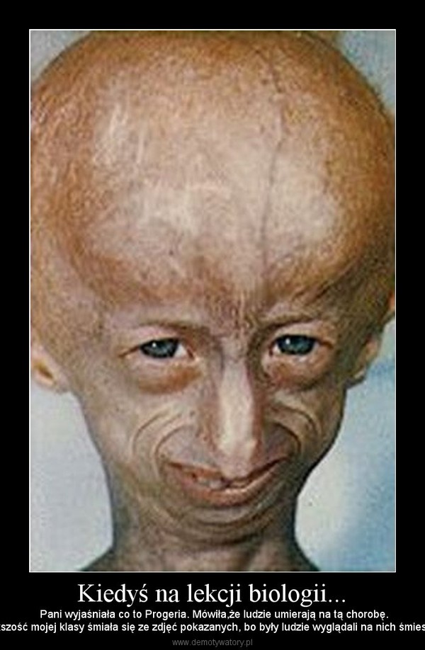 Kiedyś na lekcji biologii... –  Pani wyjaśniała co to Progeria. Mówiła,że ludzie umierają na tą chorobę.Większość mojej klasy śmiała się ze zdjęć pokazanych, bo były ludzie wyglądali na nich śmiesznie. 