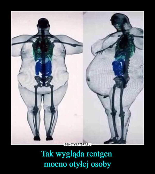 Tak wygląda rentgen mocno otyłej osoby –  