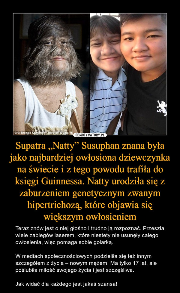 Supatra „Natty” Susuphan znana była jako najbardziej owłosiona dziewczynka na świecie i z tego powodu trafiła do księgi Guinnessa. Natty urodziła się z zaburzeniem genetycznym zwanym hipertrichozą, które objawia się większym owłosieniem