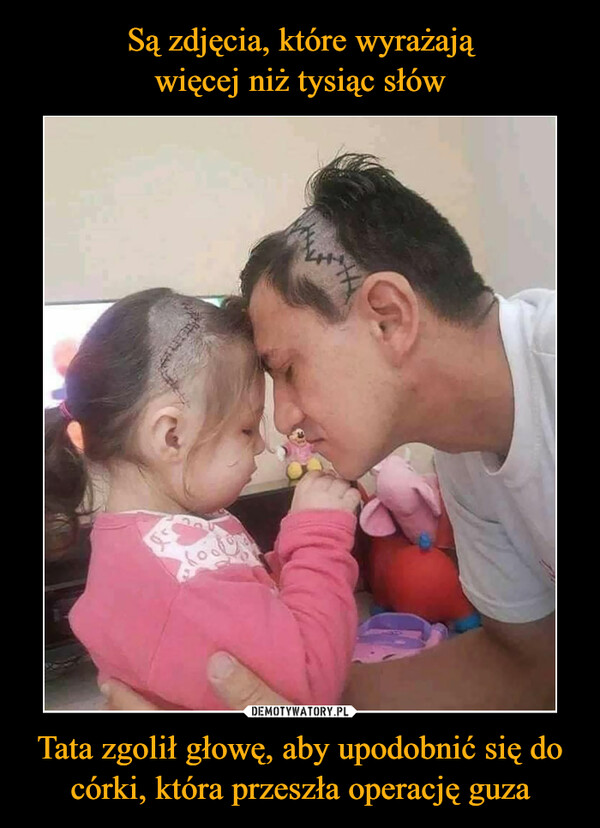 Tata zgolił głowę, aby upodobnić się do córki, która przeszła operację guza –  