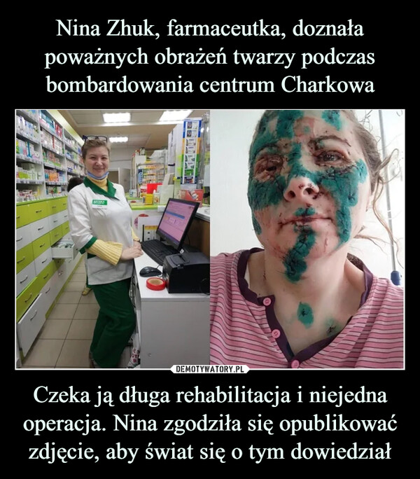 Nina Zhuk, farmaceutka, doznała poważnych obrażeń twarzy podczas bombardowania centrum Charkowa Czeka ją długa rehabilitacja i niejedna operacja. Nina zgodziła się opublikować zdjęcie, aby świat się o tym dowiedział