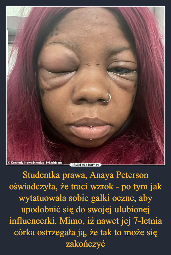 Studentka prawa, Anaya Peterson oświadczyła, że traci wzrok - po tym jak wytatuowała sobie gałki oczne, aby upodobnić się do swojej ulubionej influencerki. Mimo, iż nawet jej 7-letnia córka ostrzegała ją, że tak to może się zakończyć –  